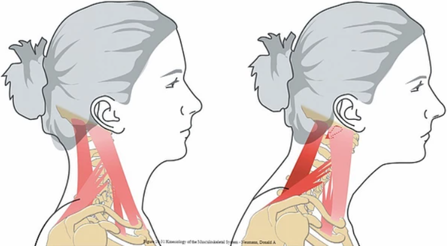 Forward Head Posture 이미지